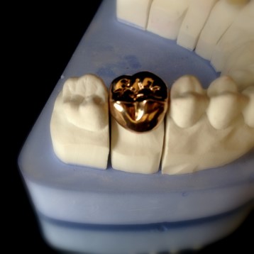 Ceramic Crowns in Chromium Nickel Support