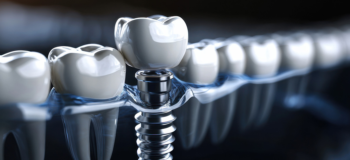 Dental Implants in Romania