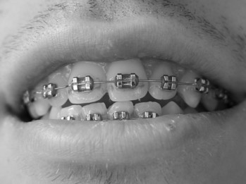 Fixed Orthodontic Appliances