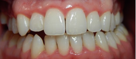 Gingival Graft in Romania