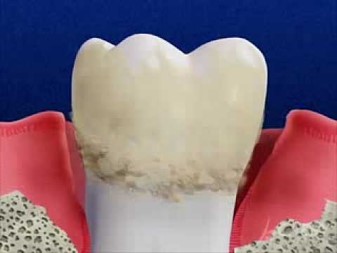 Periodontitis Treatment in Romania