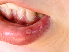Stomatitis Treatments in Romania