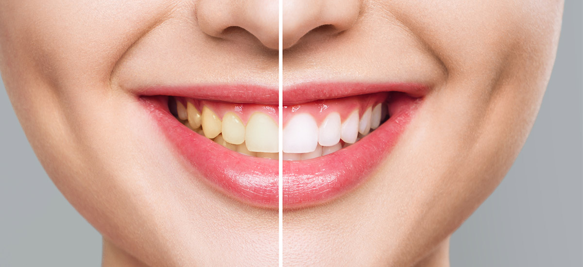 Teeth Whitening in Romania