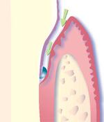The Gingival and Subgingival Curettage in Romania