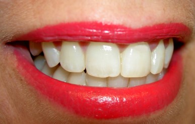 Blanchiment des dents en Roumanie