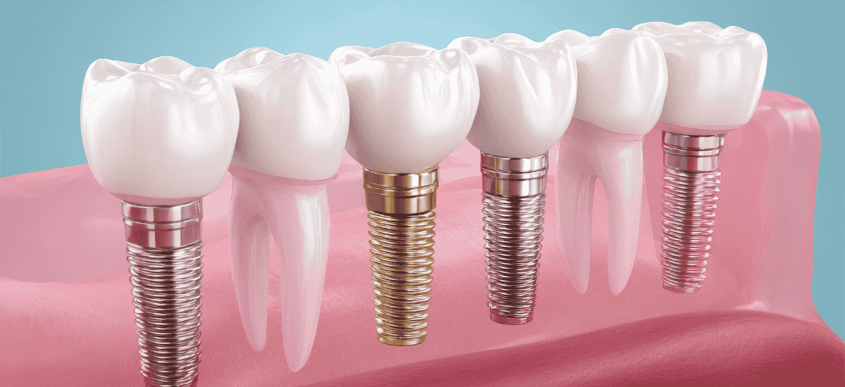 Implanturi Dentare in Romania